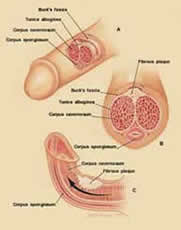 Induratio penis plastica - (IPP)